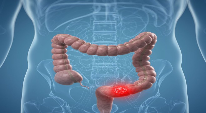 Colon Cancer Symptoms: Why Youngsters Are Prone To This Deadly ...